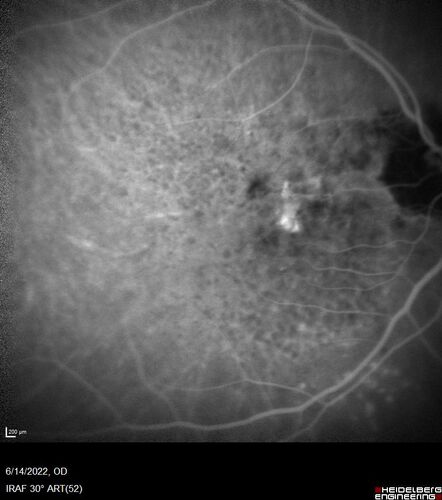 wet AMD - extrafoveal classic choroidal neovascular membrane
72 year old man with good vision in both eyes.  Extrafoveal classic cnvm was picked up and treated with vabysmo
