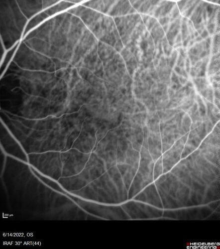 wet AMD - extrafoveal classic choroidal neovascular membrane
72 year old man with good vision in both eyes.  Extrafoveal classic cnvm was picked up and treated with vabysmo
