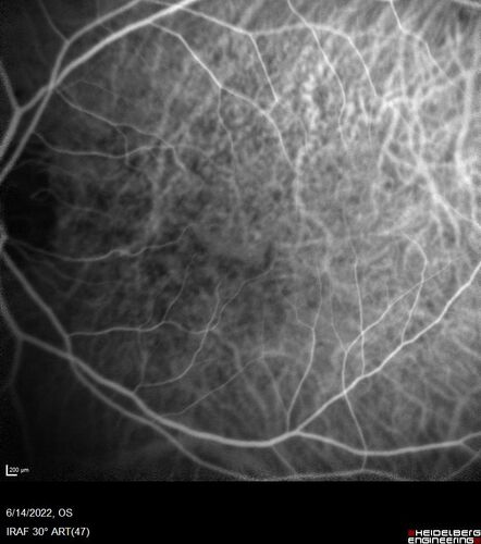 wet AMD - extrafoveal classic choroidal neovascular membrane
72 year old man with good vision in both eyes.  Extrafoveal classic cnvm was picked up and treated with vabysmo
