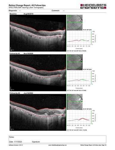 wet AMD - extrafoveal classic choroidal neovascular membrane
72 year old man with good vision in both eyes.  Extrafoveal classic cnvm was picked up and treated with vabysmo
