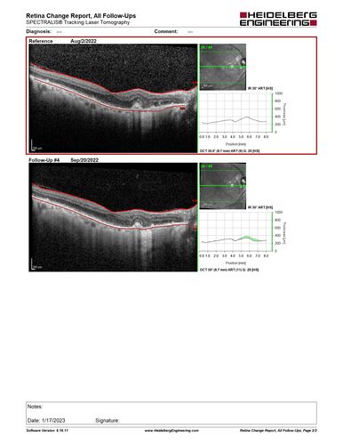 wet AMD - extrafoveal classic choroidal neovascular membrane
72 year old man with good vision in both eyes.  Extrafoveal classic cnvm was picked up and treated with vabysmo
