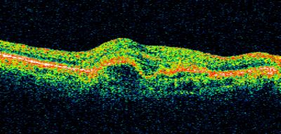 Wet AMD - Subfoveal CNVM - Excellent Response to Avastin
76-year-old woman two to three months of vision loss OD

Vision started at 20/200 and with Avastin improved to 20/25.  She has required monthly injections and as of October 2010 has been treated about 16 times.  Her left eye remains good at 20/20. 

The OCT from post-treatment as well as pretreatment images are in this album.
