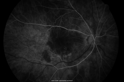 Wet AMD - Subfoveal CNVM - Excellent Response to Avastin
76-year-old woman two to three months of vision loss OD

Vision started at 20/200 and with Avastin improved to 20/25.  She has required monthly injections and as of October 2010 has been treated about 16 times.  Her left eye remains good at 20/20. 

The OCT from post-treatment as well as pretreatment images are in this album.
