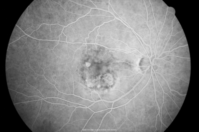 Wet AMD - Subfoveal CNVM - Excellent Response to Avastin
76-year-old woman two to three months of vision loss OD

Vision started at 20/200 and with Avastin improved to 20/25.  She has required monthly injections and as of October 2010 has been treated about 16 times.  Her left eye remains good at 20/20. 

The OCT from post-treatment as well as pretreatment images are in this album.
