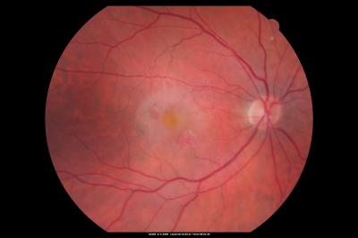 Wet AMD - Subfoveal CNVM - Excellent Response to Avastin
76-year-old woman two to three months of vision loss OD

Vision started at 20/200 and with Avastin improved to 20/25.  She has required monthly injections and as of October 2010 has been treated about 16 times.  Her left eye remains good at 20/20. 

The OCT from post-treatment as well as pretreatment images are in this album.
