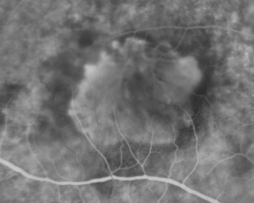 Classic Subfoveal Choroidal Neovascular Membrane - 20/400 Vision - 6 - 12 months old lesion
78-year-old woman six months or a year ago decreasing vision in the right eye.   OD 20/400. Fluorescein angiography shows a classic subfoveal choroidal neovascular membrane  in the right eye 3 disc-diameters across, which has brisk leakage.  The left eye shows staining drusen.  

Võtmesõnad: choroidal neovascular membrane;classic;subfoveal;cartwheel