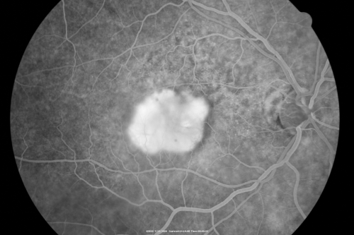 Classic Subfoveal Choroidal Neovascular Membrane - 20/400 Vision - 6 - 12 months old lesion
78-year-old woman six months or a year ago decreasing vision in the right eye.   OD 20/400. Fluorescein angiography shows a classic subfoveal choroidal neovascular membrane  in the right eye 3 disc-diameters across, which has brisk leakage.  The left eye shows staining drusen.  

Keywords: choroidal neovascular membrane;classic;subfoveal;cartwheel