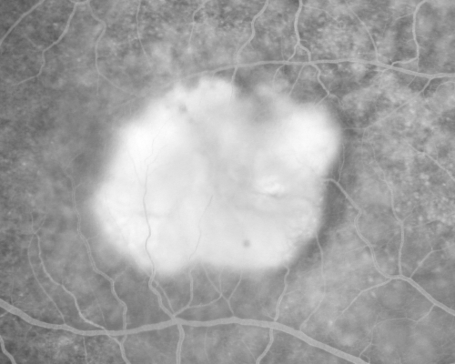 Classic Subfoveal Choroidal Neovascular Membrane - 20/400 Vision - 6 - 12 months old lesion
78-year-old woman six months or a year ago decreasing vision in the right eye.   OD 20/400. Fluorescein angiography shows a classic subfoveal choroidal neovascular membrane  in the right eye 3 disc-diameters across, which has brisk leakage.  The left eye shows staining drusen.  

Keywords: choroidal neovascular membrane;classic;subfoveal;cartwheel
