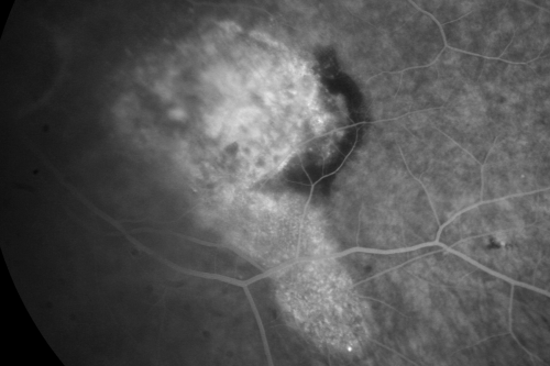 Wet Macular Degeneration Left Eye with Gutter (atypical) and Geographic Atrophy Right Eye
80-year-old man has wet age-related macular degeneration in his left eye. He has an atypical angiogram and that there is a gutter under the choroidal neovascular membrane suggesting still leakage of subretinal fluid.  OS 20/400.
