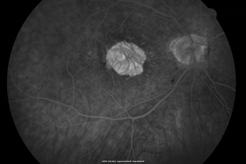 Wet Macular Degeneration Left Eye with Gutter (atypical) and Geographic Atrophy Right Eye
80-year-old man has wet age-related macular degeneration in his left eye. He has an atypical angiogram and that there is a gutter under the choroidal neovascular membrane suggesting still leakage of subretinal fluid.  OS 20/400.
