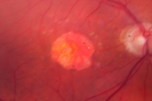 Wet Macular Degeneration Left Eye with Gutter (atypical) and Geographic Atrophy Right Eye
80-year-old man has wet age-related macular degeneration in his left eye. He has an atypical angiogram and that there is a gutter under the choroidal neovascular membrane suggesting still leakage of subretinal fluid.  OS 20/400.

