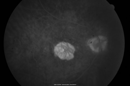Wet Macular Degeneration Left Eye with Gutter (atypical) and Geographic Atrophy Right Eye
80-year-old man has wet age-related macular degeneration in his left eye. He has an atypical angiogram and that there is a gutter under the choroidal neovascular membrane suggesting still leakage of subretinal fluid.  OS 20/400.
