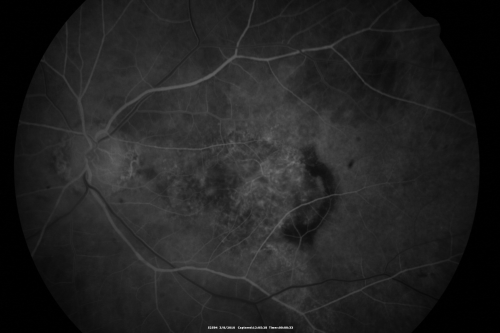 Wet Macular Degeneration Left Eye with Gutter (atypical) and Geographic Atrophy Right Eye
80-year-old man has wet age-related macular degeneration in his left eye. He has an atypical angiogram and that there is a gutter under the choroidal neovascular membrane suggesting still leakage of subretinal fluid.  OS 20/400.
