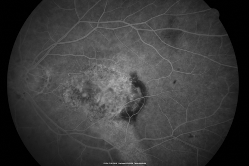 Wet Macular Degeneration Left Eye with Gutter (atypical) and Geographic Atrophy Right Eye
80-year-old man has wet age-related macular degeneration in his left eye. He has an atypical angiogram and that there is a gutter under the choroidal neovascular membrane suggesting still leakage of subretinal fluid.  OS 20/400.

