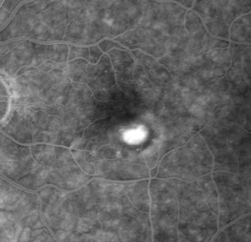 Wet AMD 62 year old male smoker 
62-year-old man has wet age-related macular degeneration in the right eye.  He has been undergoing treatment with Lucentis for that.  Then his left eye developed hazy vision a few weeks ago while he was overseas and now his vision is hazy in both eyes.   OD 20/40, OS 20/30.    FA shows a classic subfoveal choroidal neovascular membrane in the left eye, which is leaking and in the right eye, which is dry. He is going to stop smoking today. FU: VA 20/30 OU with 2 years of every 6 weeks bilateral avastin!
Palabras clave: wet amd; smoker; avastin; bilateral