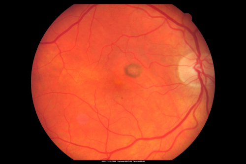 Wet AMD 62 year old male smoker 
62-year-old man has wet age-related macular degeneration in the right eye.  He has been undergoing treatment with Lucentis for that.  Then his left eye developed hazy vision a few weeks ago while he was overseas and now his vision is hazy in both eyes.   OD 20/40, OS 20/30.    FA shows a classic subfoveal choroidal neovascular membrane in the left eye, which is leaking and in the right eye, which is dry. He is going to stop smoking today. FU: VA 20/30 OU with 2 years of every 6 weeks bilateral avastin!
Keywords: wet amd; smoker; avastin; bilateral