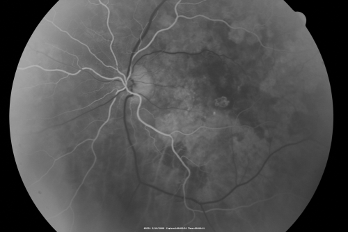 Wet AMD 62 year old male smoker 
62-year-old man has wet age-related macular degeneration in the right eye.  He has been undergoing treatment with Lucentis for that.  Then his left eye developed hazy vision a few weeks ago while he was overseas and now his vision is hazy in both eyes.   OD 20/40, OS 20/30.    FA shows a classic subfoveal choroidal neovascular membrane in the left eye, which is leaking and in the right eye, which is dry. He is going to stop smoking today. FU: VA 20/30 OU with 2 years of every 6 weeks bilateral avastin!
Keywords: wet amd; smoker; avastin; bilateral