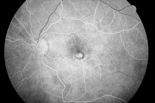 Wet AMD 62 year old male smoker 
62-year-old man has wet age-related macular degeneration in the right eye.  He has been undergoing treatment with Lucentis for that.  Then his left eye developed hazy vision a few weeks ago while he was overseas and now his vision is hazy in both eyes.   OD 20/40, OS 20/30.    FA shows a classic subfoveal choroidal neovascular membrane in the left eye, which is leaking and in the right eye, which is dry. He is going to stop smoking today. FU: VA 20/30 OU with 2 years of every 6 weeks bilateral avastin!
Keywords: wet amd; smoker; avastin; bilateral