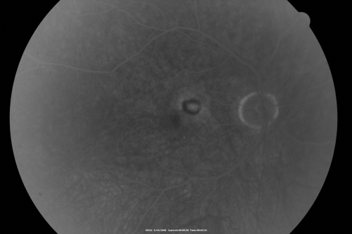 Wet AMD 62 year old male smoker 
62-year-old man has wet age-related macular degeneration in the right eye.  He has been undergoing treatment with Lucentis for that.  Then his left eye developed hazy vision a few weeks ago while he was overseas and now his vision is hazy in both eyes.   OD 20/40, OS 20/30.    FA shows a classic subfoveal choroidal neovascular membrane in the left eye, which is leaking and in the right eye, which is dry.
 He is going to stop smoking today.

Keywords: wet amd; smoker; avastin; bilateral