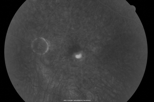 Wet AMD 62 year old male smoker 
62-year-old man has wet age-related macular degeneration in the right eye.  He has been undergoing treatment with Lucentis for that.  Then his left eye developed hazy vision a few weeks ago while he was overseas and now his vision is hazy in both eyes.   OD 20/40, OS 20/30.    FA shows a classic subfoveal choroidal neovascular membrane in the left eye, which is leaking and in the right eye, which is dry. He is going to stop smoking today. FU: VA 20/30 OU with 2 years of every 6 weeks bilateral avastin!
Keywords: wet amd; smoker; avastin; bilateral