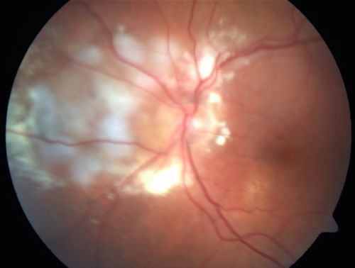 Wet Macular Degeneration with Juxtapapillary Neovascular Membrane and Choroidal Laser Treatment
87-year-old woman has wet age-related macular degeneration in the left eye with an extrafoveal choroidal neovascular membrane OD is 20/25, OS is 20/25
