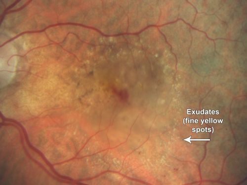 Wet AMD - PED with exudate 20/400 87 Year old
87-year-old woman has wet age-related macular degeneration in the left eye.    Vision OD is 20/25, OS is 20/400
