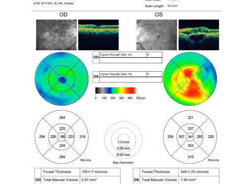 Pigment Epithelial Detachment with Subretinal Fluid and Exudate 20/400 Vision
87-year-old woman has wet age-related macular degeneration in the left eye.  She had treatment up north but there has been a gap in therapy and the vision in the left eye is poor.  Vision OD is 20/25, OS is 20/400

