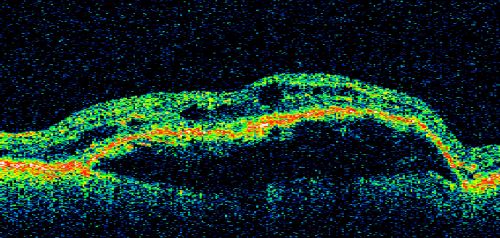 Pigment Epithelial Detachment with Subretinal Fluid and Exudate 20/400 Vision
87-year-old woman has wet age-related macular degeneration in the left eye.  She had treatment up north but there has been a gap in therapy and the vision in the left eye is poor.  Vision OD is 20/25, OS is 20/400
