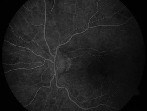 Wet AMD - PED with exudate 20/400 87 Year old
87-year-old woman has wet age-related macular degeneration in the left eye.    Vision OD is 20/25, OS is 20/400
