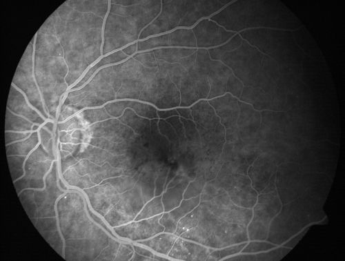 Pigment Epithelial Detachment with Subretinal Fluid and Exudate 20/400 Vision
87-year-old woman has wet age-related macular degeneration in the left eye.  She had treatment up north but there has been a gap in therapy and the vision in the left eye is poor.  Vision OD is 20/25, OS is 20/400
