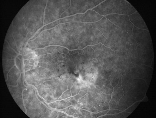 Pigment Epithelial Detachment with Subretinal Fluid and Exudate 20/400 Vision
87-year-old woman has wet age-related macular degeneration in the left eye.  She had treatment up north but there has been a gap in therapy and the vision in the left eye is poor.  Vision OD is 20/25, OS is 20/400
