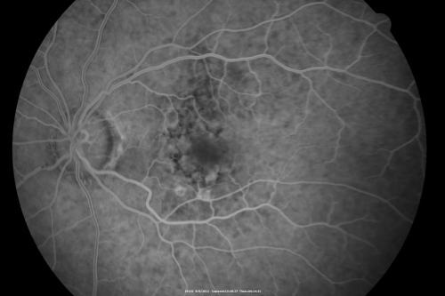 Wet AMD controlled with Avastin 20/60 Vision
79-year-old woman has wet age-related macular degeneration in both eyes.  The left eye had intravitreal injections of Avastin starting in May of 2009.  Her vision remains good in the left eye and poor in the right eye.  

VISUAL ACUITY:  OD 8/200,  OS 20/60.
