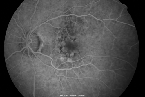 Wet AMD controlled with Avastin 20/60 Vision
79-year-old woman has wet age-related macular degeneration in both eyes.  The left eye had intravitreal injections of Avastin starting in May of 2009.  Her vision remains good in the left eye and poor in the right eye.  

VISUAL ACUITY:  OD 8/200,  OS 20/60.
