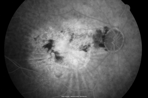 Chorioretinal Scar with Radiating Chorioretinal Folds
79-year-old woman has wet age-related macular degeneration in both eyes.  The left eye had intravitreal injections of Avastin starting in May of 2009.  Her vision remains good in the left eye and poor in the right eye.  

VISUAL ACUITY:  OD 8/200,  OS 20/60.
