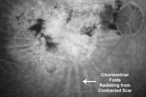 Chorioretinal Scar with Radiating Chorioretinal Folds
79-year-old woman has wet age-related macular degeneration in both eyes.  The left eye had intravitreal injections of Avastin starting in May of 2009.  Her vision remains good in the left eye and poor in the right eye.  

VISUAL ACUITY:  OD 8/200,  OS 20/60.
