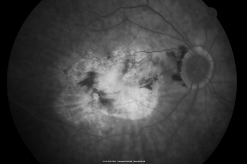 Chorioretinal Scar with Radiating Chorioretinal Folds
79-year-old woman has wet age-related macular degeneration in both eyes.  The left eye had intravitreal injections of Avastin starting in May of 2009.  Her vision remains good in the left eye and poor in the right eye.  

VISUAL ACUITY:  OD 8/200,  OS 20/60.
