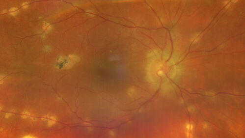 West Nile Virus Multifocal Choroiditis with later CNVM
77 year old female with vision loss in the left eye treated with Anti-VEGF
