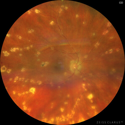 West Nile Virus Multifocal Choroiditis with later CNVM
77 year old female with vision loss in the left eye treated with Anti-VEGF
