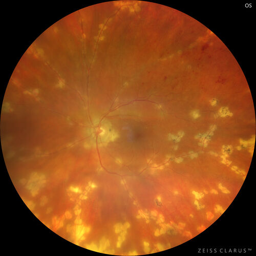 West Nile Virus Multifocal Choroiditis with later CNVM
77 year old female with vision loss in the left eye treated with Anti-VEGF
