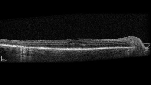 West Nile Virus Multifocal Choroiditis with later CNVM
77 year old female with vision loss in the left eye treated with Anti-VEGF

