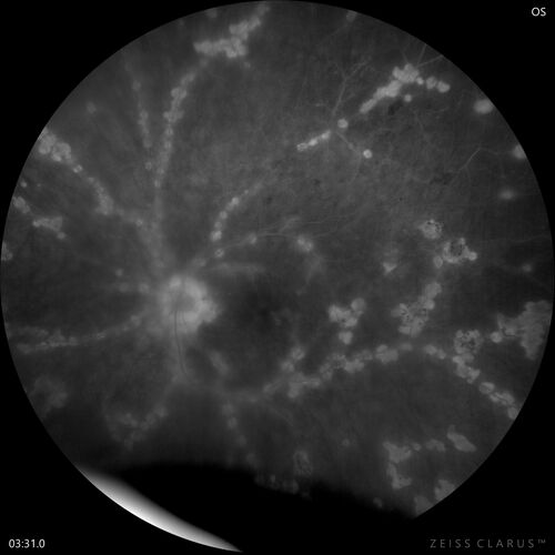West Nile Virus Multifocal Choroiditis with later CNVM
77 year old female with vision loss in the left eye treated with Anti-VEGF

