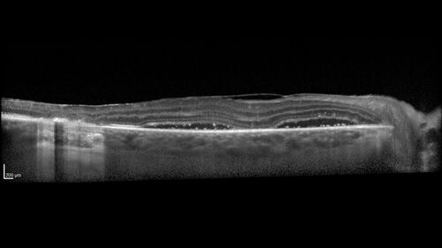 West Nile Virus Multifocal Choroiditis with later CNVM
77 year old female with vision loss in the left eye treated with Anti-VEGF
