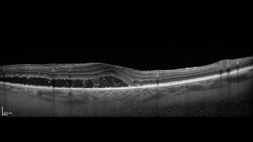 West Nile Virus Multifocal Choroiditis with later CNVM
77 year old female with vision loss in the left eye treated with Anti-VEGF
