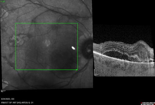 West Nile Virus Multifocal Choroiditis with later CNVM
77 year old female with vision loss in the left eye treated with Anti-VEGF
