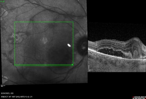 West Nile Virus Multifocal Choroiditis with later CNVM
77 year old female with vision loss in the left eye treated with Anti-VEGF
