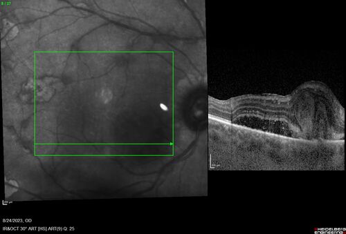West Nile Virus Multifocal Choroiditis with later CNVM
77 year old female with vision loss in the left eye treated with Anti-VEGF
