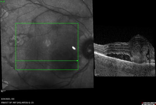 West Nile Virus Multifocal Choroiditis with later CNVM
77 year old female with vision loss in the left eye treated with Anti-VEGF
