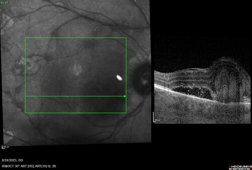 West Nile Virus Multifocal Choroiditis with later CNVM
77 year old female with vision loss in the left eye treated with Anti-VEGF
