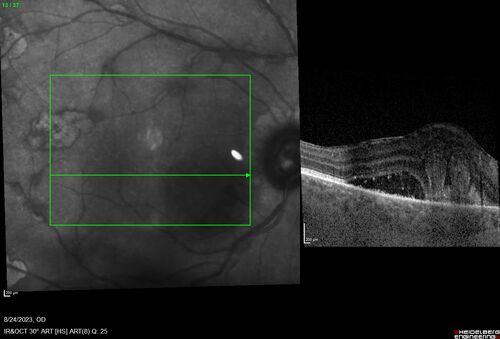 West Nile Virus Multifocal Choroiditis with later CNVM
77 year old female with vision loss in the left eye treated with Anti-VEGF

