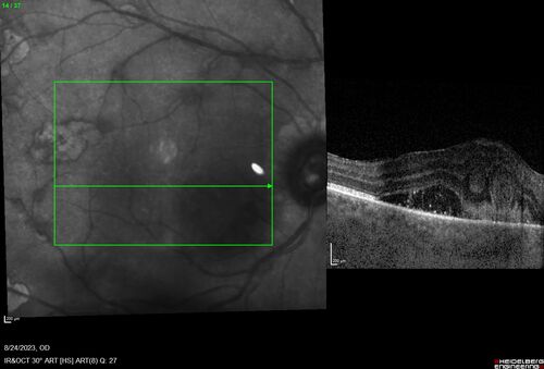 West Nile Virus Multifocal Choroiditis with later CNVM
77 year old female with vision loss in the left eye treated with Anti-VEGF
